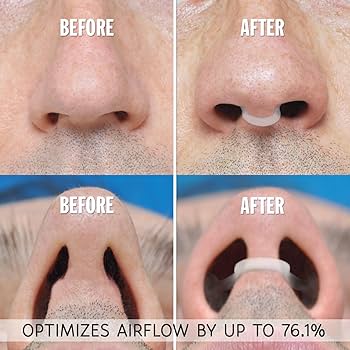 ZALUNAS Serene – Premium Anti-Snore Mouthpiece + Free Premium Nasal Dilator